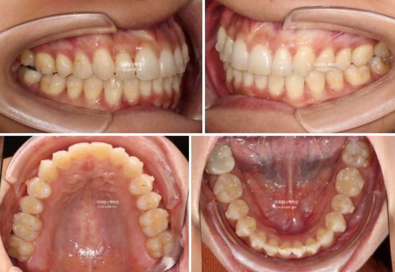 인비절라인 비발치 덧니 교정 반대교합 치료 후기 관련 이미지 12