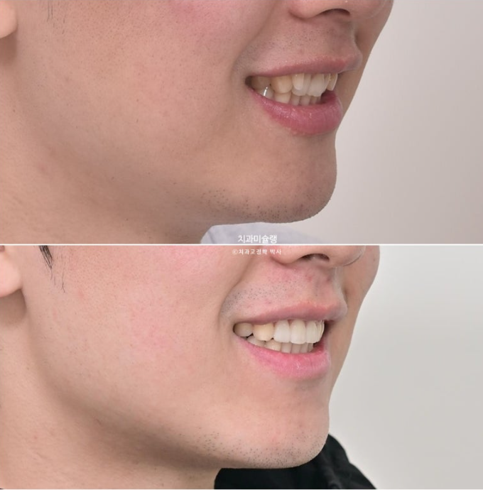 옥니 덧니 교정 왜소치 선천적 결손 3전치 무삭제 라미네이트 인비절라인 교정 관련 이미지 2
