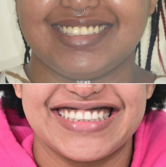 Extraction & re-orthodontics with Clippy-C, intrusion for dental implant. 관련 이미지 21