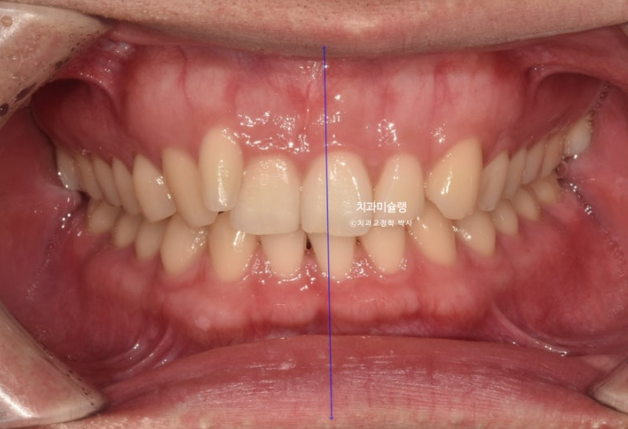 옥니 덧니 교정 왜소치 선천적 결손 3전치 무삭제 라미네이트 인비절라인 교정 관련 이미지 3