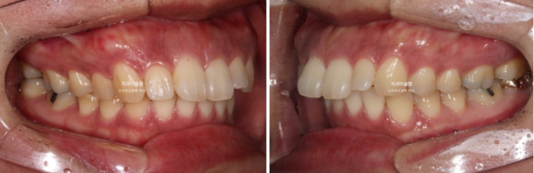 Extraction Orthodontics with Clippy-C for Protruding Mouth, Gum Smile, Gummy Smile Correction, and Treatment for a Recessed Chin image 3