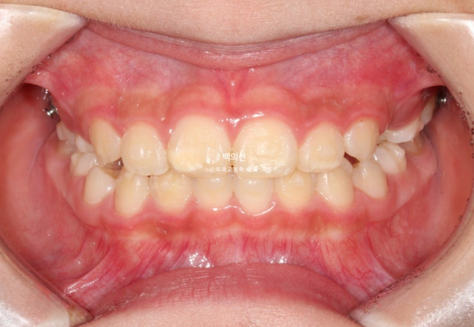 소아 비대칭 교정 인비절라인 퍼스트 재제작 1회 MA 치료 관련 이미지 11