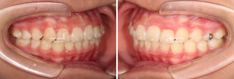 덧니 반대교합 과개교합 인비절라인 퍼스트 악궁확장 어린이 교정 치료 관련 이미지 11