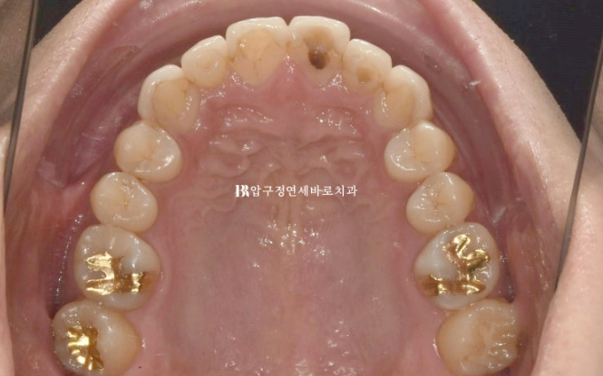 40대 치아교정 인비절라인 라이트 덧니 교정 어금니 교합 부작용 관련 이미지 4