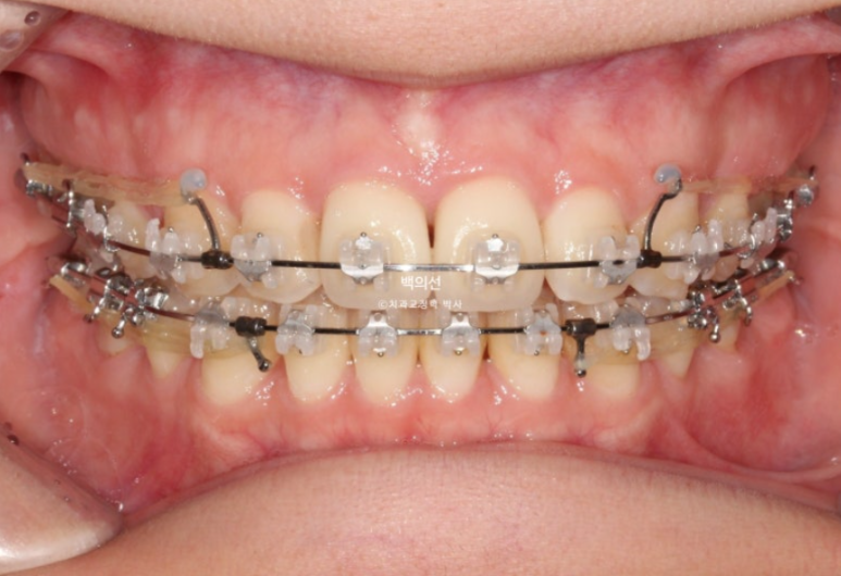 클리피씨 교정에서 인비절라인 변경 마무리 인비절라인 라이트 치료기간 4개월 관련 이미지 1