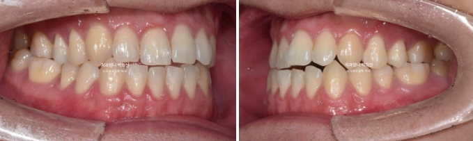 MSE Palatal Expansion Invisalign Underbite Correction, Non-Surgical image 3