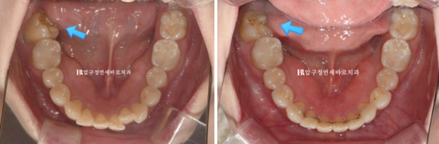 40대 인비절라인 라이트 가위교합? 관련 이미지 16