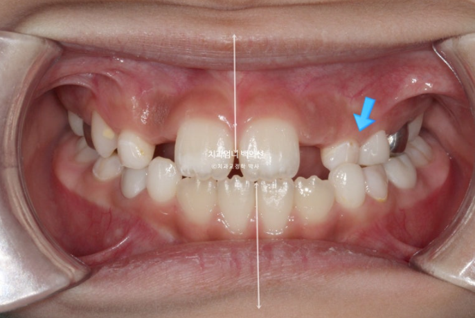 어린이 교정 인비절라인 퍼스트 비대칭 반대교합 어린이 성장 교정 관련 이미지 3