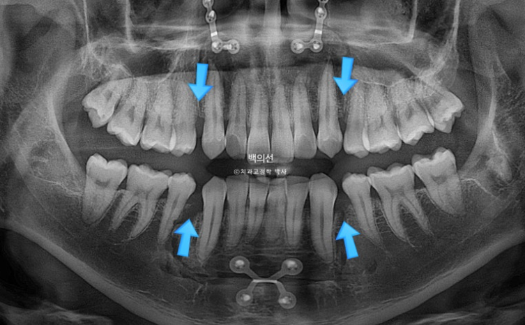 돌출입 수술 ASO + 인비절라인 라이트 후교정 치료기간 10개월 관련 이미지 4