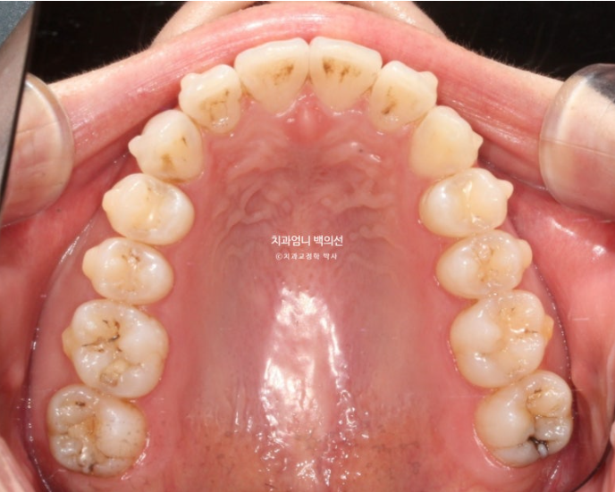 인비절라인 라이트 교정 앞니돌출 과개교합 덧니 교정 관련 이미지 7