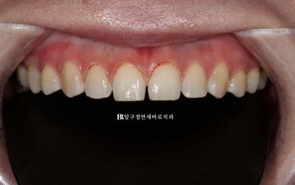 Four No-Prep Veneers for Dwarf Teeth and Conical Front Teeth image 4