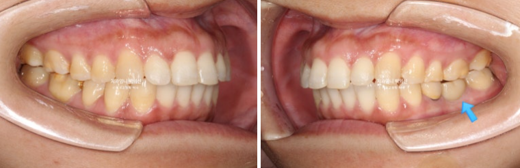 40대 인비절라인 라이트 앞니 벌어짐 뻗침 돌출 치료 관련 이미지 14