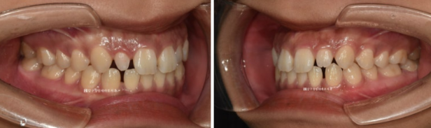 왜소치 인비절라인 라이트 교정 / 무삭제 라미네이트 젤라미 관련 이미지 4