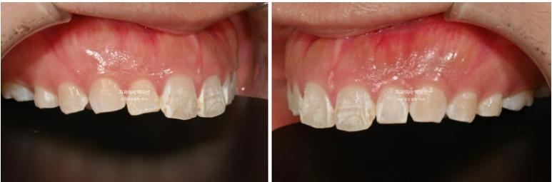 반점치 반상치 치아 하얀 얼룩 치료하기 관련 이미지 4