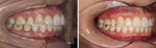 Orthodontic Retreatment in Your 40s | Improvement of Chin Retrusion and Lip Incompetence with Intrusion Orthodontics, Non-Extraction Orthodontic Treatment in Your 40s image 6