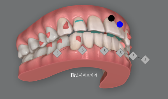50대 치아벌어짐 단기 교정 가능할까요? 관련 이미지 7