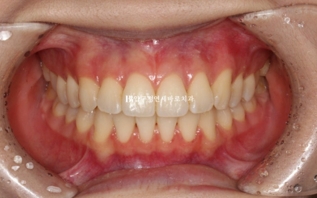 Orthodontic Treatment for International Students: Is Short-Term Treatment Possible in Korea? | A Real 5-Month Front Teeth Partial Orthodontic Case image 6