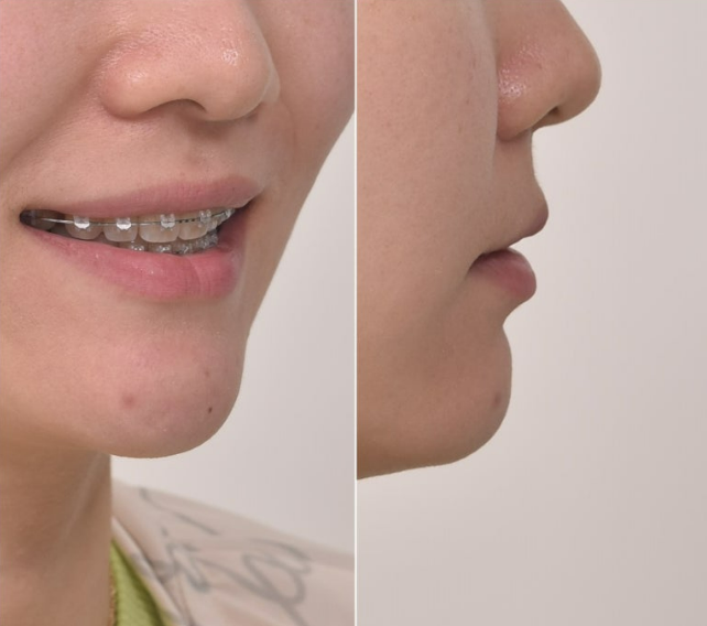 30대 돌출입 발치교정 입술부전증 치료 관련 이미지 5