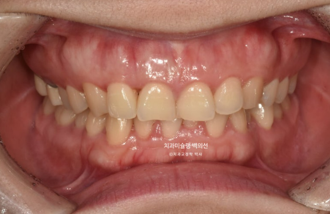 비발치 덧니 교정 인비절라인 과개교합 교정 무삭제 라미네이트 치료 후기 관련 이미지 2