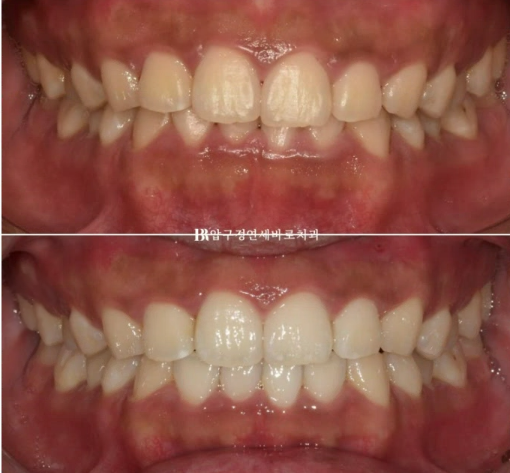 압구정 인비절라인 라이트 과개교합 후기 관련 이미지 10