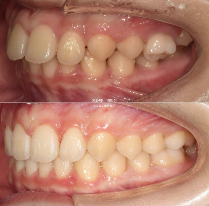 어린이 투명교정 인비절라인 퍼스트 가위교합 돌출교정 덧니교정 관련 이미지 14