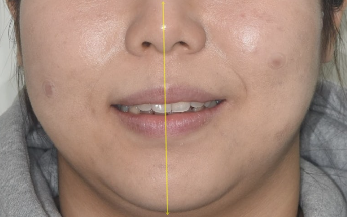 돌출입 교정 인비절라인 발치 교정 개방교합 치료 후기 관련 이미지 6