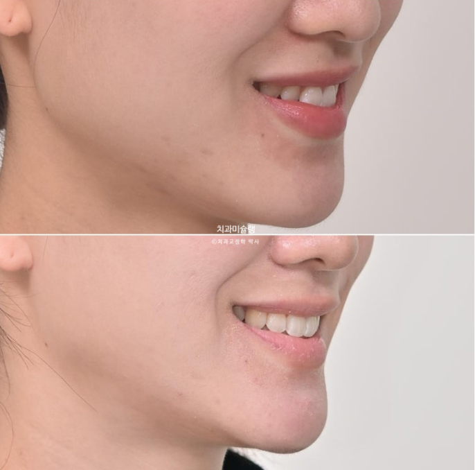 인비절라인 비발치 토끼이빨 교정 덧니 교정 치료기간 1년 8개월 관련 이미지 16