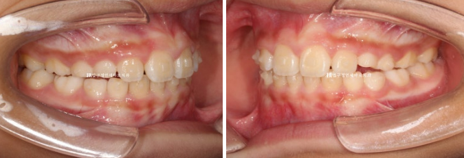 Invisalign First Correction for a Retruded Chin in a Child Orthodontic Treatment for Protrusion image 14