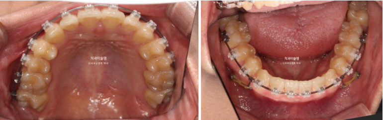 비발치 비수술 주걱턱 반대교합 재교정 치료 관련 이미지 8