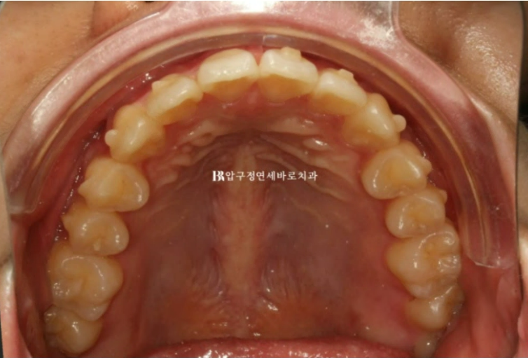 인비절라인 익스프레스 토끼이빨 앞니교정 ? 관련 이미지 8