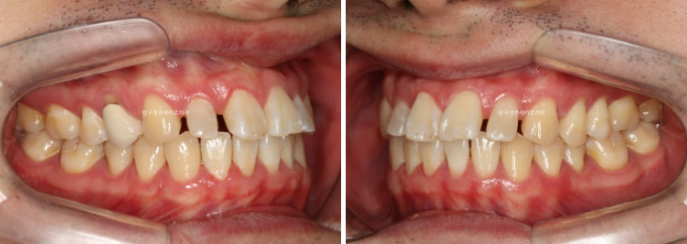 인비절라인 라이트 후 무삭제 라미네이트 치료 관련 이미지 1