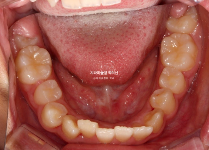 덧니 반대교합 과개교합 인비절라인 퍼스트 악궁확장 어린이 교정 치료 관련 이미지 5