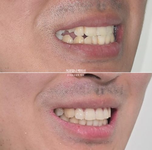 반대교합 비발치 교정 클리피씨 후기 관련 이미지 13