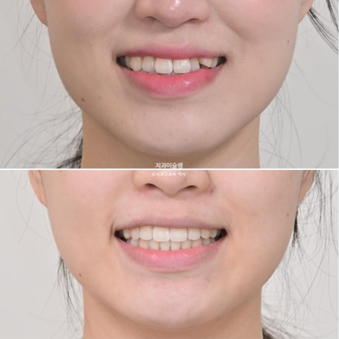 인비절라인 라이트 반대교합? 덧니 중심선 치간삭제 치료 관련 이미지 1