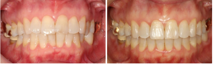 40대 후반 치아교정 해도 될까요? 관련 이미지 5