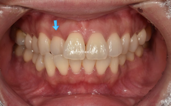 Short-Term Orthodontic Treatment Period for an Overseas Korean in Their 40s with Anterior Crossbite and Buck Teeth image 2