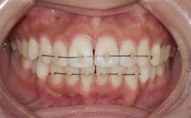 Can Rabbit Teeth Be Corrected? 5-Month Real Case of Butterfly Teeth Anterior Partial Orthodontic Treatment image 6