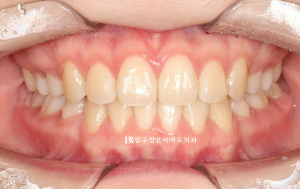 인비절라인 돌출입 발치교정, 정말 결과가 안 좋을까요? 관련 이미지 12