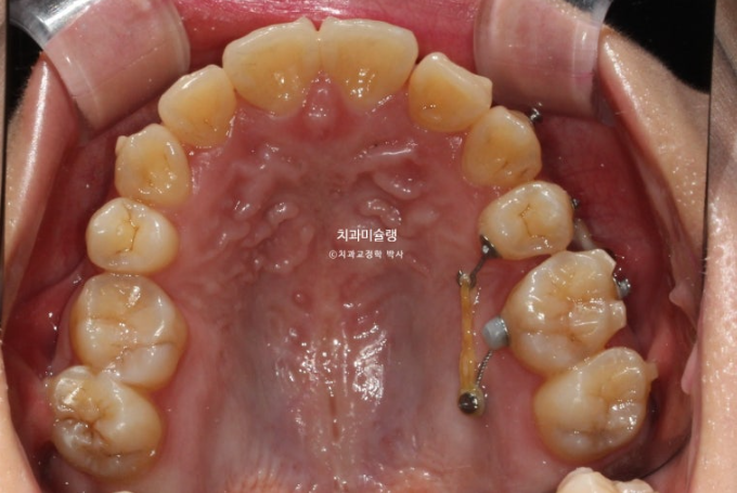 30대 인비절라인 덧니 발치교정 개방교합 치료 관련 이미지 11