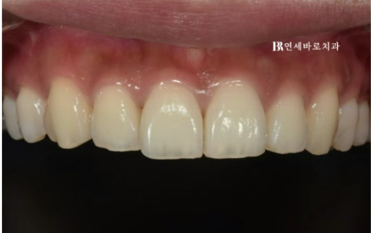 압구정 무삭제 라미네이트 가능할까? 관련 이미지 1