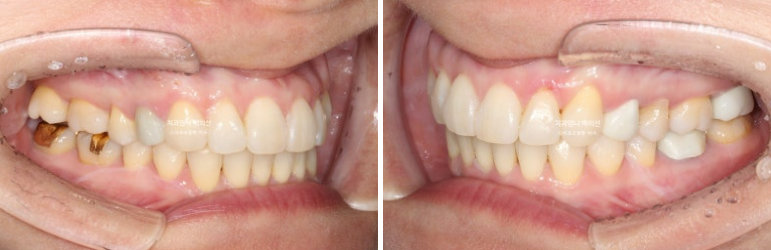 50대 치아교정 교합평면 기울어짐 토끼이 덧니 교정? 관련 이미지 9