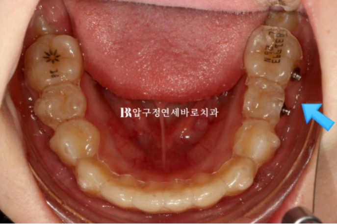 인비절라인 퍼스트, 결국 다시 교정해야 할까? 관련 이미지 9