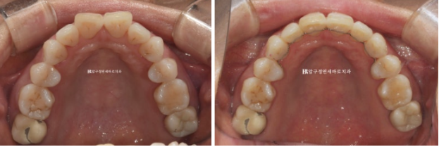 강남 중장년 교정|40~50대 잇몸이 약해도 교정할 수 있을까요? 잇몸퇴축 관련 이미지 11