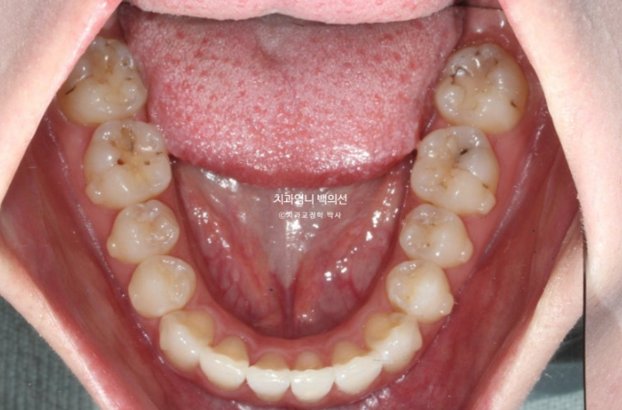 인비절라인 라이트 교정 앞니돌출 과개교합 덧니 교정 관련 이미지 8