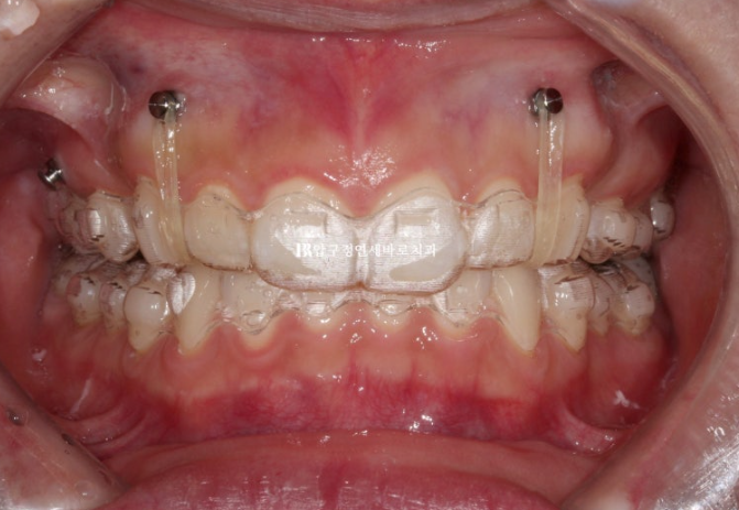 인비절라인 돌출입 발치교정 거미스마일 잇몸미소 교정 관련 이미지 4