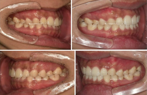 압구정 인비절라인 라이트 과개교합 후기 관련 이미지 8