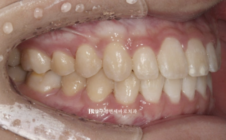 옥니교정 / 웃을때 아랫니만 보여요. 앞니 노출도 교정? 관련 이미지 8