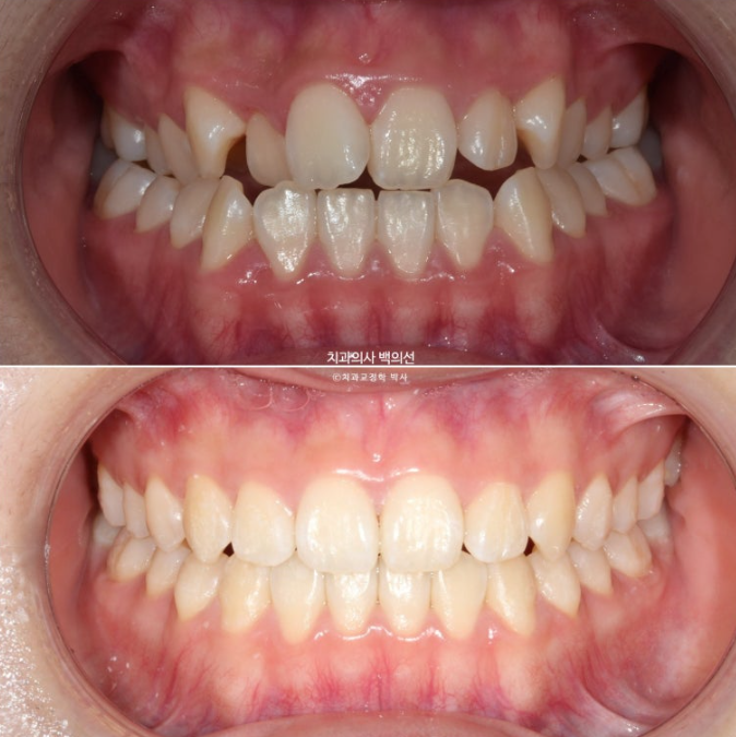 중학생 주걱턱 반대교합 개방교합 덧니 교정 인비절라인 후기 관련 이미지 10