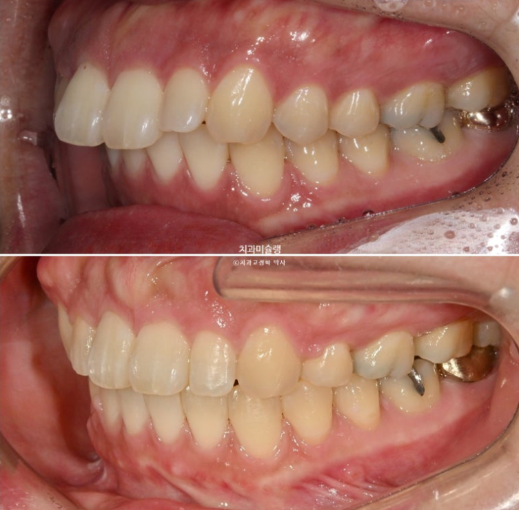 Extraction Orthodontics with Clippy-C for Protruding Mouth, Gum Smile, Gummy Smile Correction, and Treatment for a Recessed Chin image 15