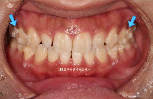 왜소치 인비절라인 라이트 교정 / 무삭제 라미네이트 젤라미 관련 이미지 5